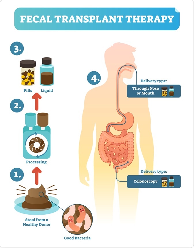 fecal transplant