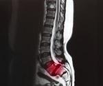 Spondylolisthesis Symptomatology