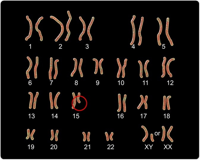 Prader-Willi syndrome