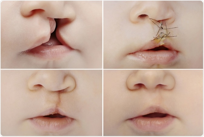 cleft palate
