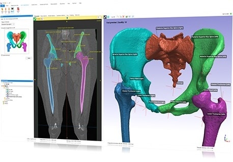 Example of Simpleware AS Ortho AI-enabled segmentation and landmarking