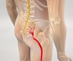 Sciatica Diagnosis