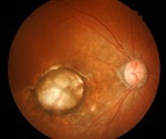 Macular Degeneration Treatment