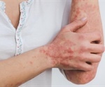 Study explains the link between psoriasis treatment and cardiovascular diseases
