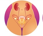 Pelvic Organ Prolapse