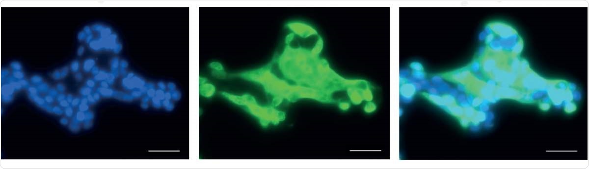 Microscopic images of cultured human lung cells infected with SARS-CoV-2. Blue (left) – staining of the cells’ nuclei; Green (center) – SARS-CoV-2 staining; Cyan (right) - cells infected with SARS-CoV-2