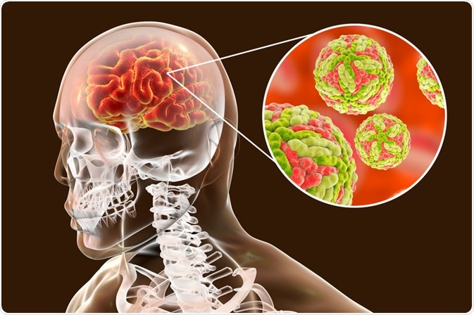 Japanese encephalitis
