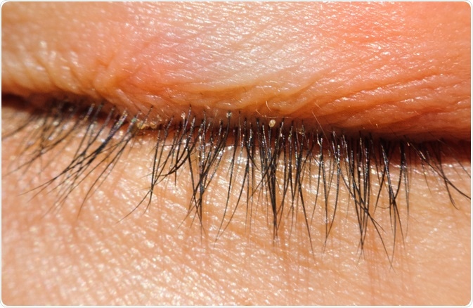 blepharitis