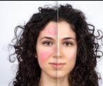 Lifestyle Changes for Rosacea