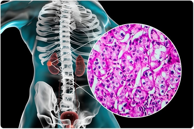 renal cell carcinoma