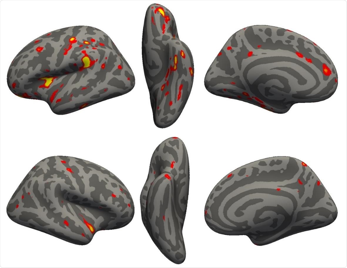 Vertex-wise longitudinal group comparison results in grey matter thickness. Thresholded map (|Z|>3) showing the strongest longitudinal differences between the 394 COVID participants and 388 controls. More prominent reduction in cortical thickness between the two scans for the COVID patients can be seen particularly in the left hemisphere in the anterior parahippocampal gyrus (perirhinal cortex), the anterior and lateral orbital gyrus, superior insula, supramarginal gyrus and anterior cingulate cortex. In the right hemisphere, there is also a notable reduction of grey matter thickness in the temporal pole (also weakly present in the left hemisphere).