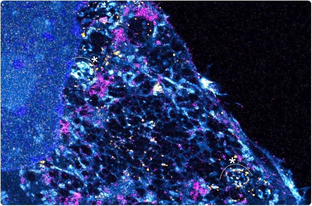 Study: Optical nanoscopy reveals SARS-CoV-2-induced remodeling of human airway cells