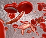 What is Sickle-Cell Disease?