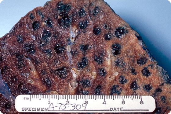 Gross pathology of lung showing centrilobular emphysema characteristic of smoking. Closeup of fixed, cut surface shows multiple cavities lined by heavy black carbon deposits.