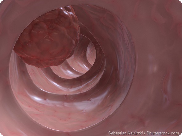 Colon cancer