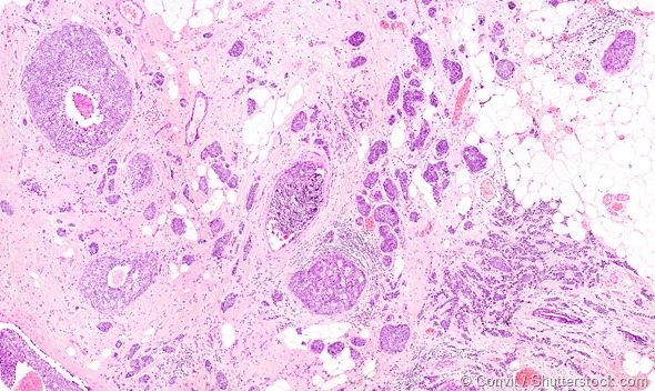 Microscope picture of breast cancer