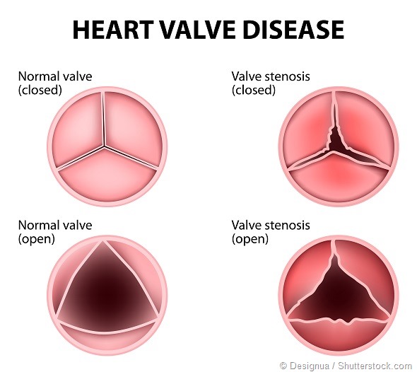 Valvular heart disease