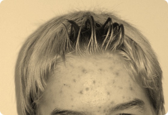 Pubescent boy with acne on his forehead.