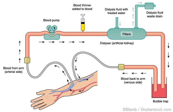 hemodialysis illustration