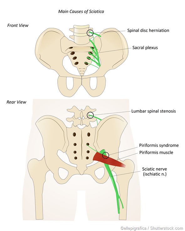 sciatica sciatic nerve