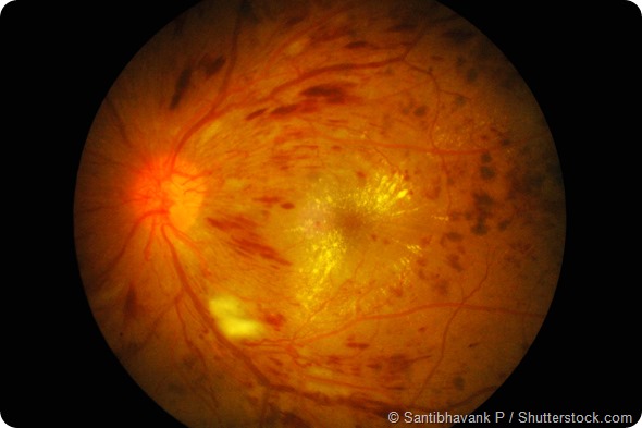 Retinal image of right eye in type I DM with finger-count visual acuity (VA) and hyperglycemia: demonstrated severe macular edema, exudates, neovascular, and numerous flame-shaped hemorrhage.