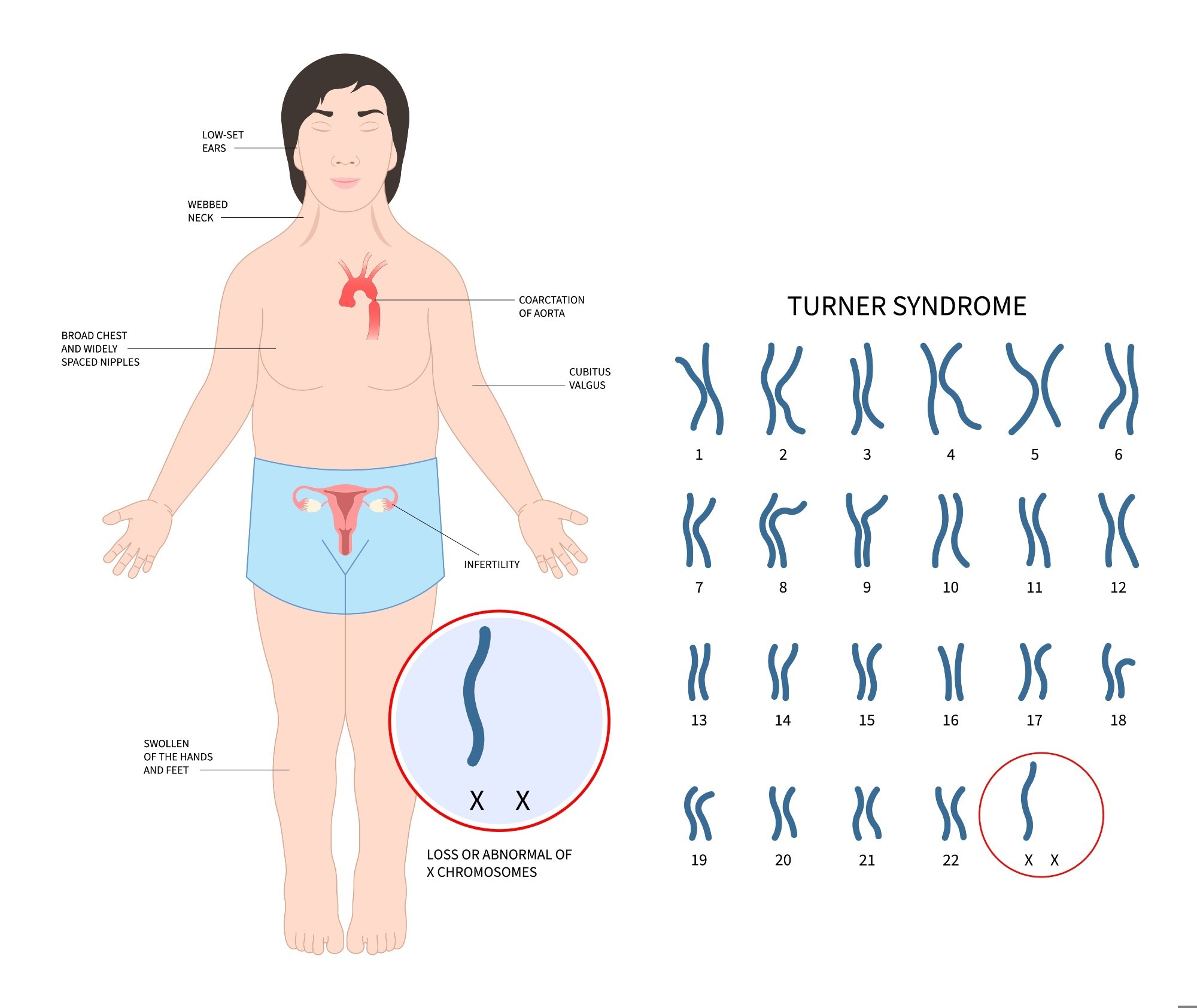 An illustration showing features of Turner Syndrome. The image includes a female figure with characteristic physical traits such as a webbed neck, low-set ears, a broad chest with widely spaced nipples, and swollen hands and feet. Medical complications like coarctation of the aorta and infertility are also highlighted. A karyotype chart indicates the loss or abnormality of one X chromosome, marked with a red circle.