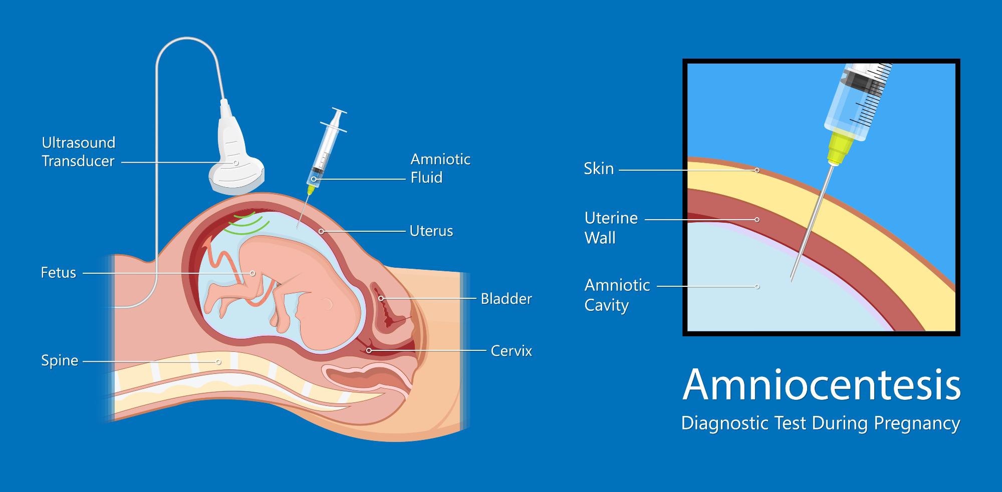 Amniocentesis