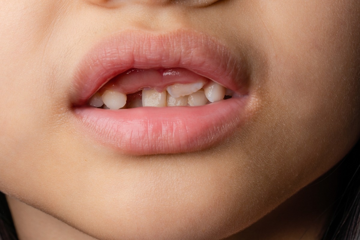 Early tooth loss is common with this condition. Image Credit: Michaelnero/Shutterstock