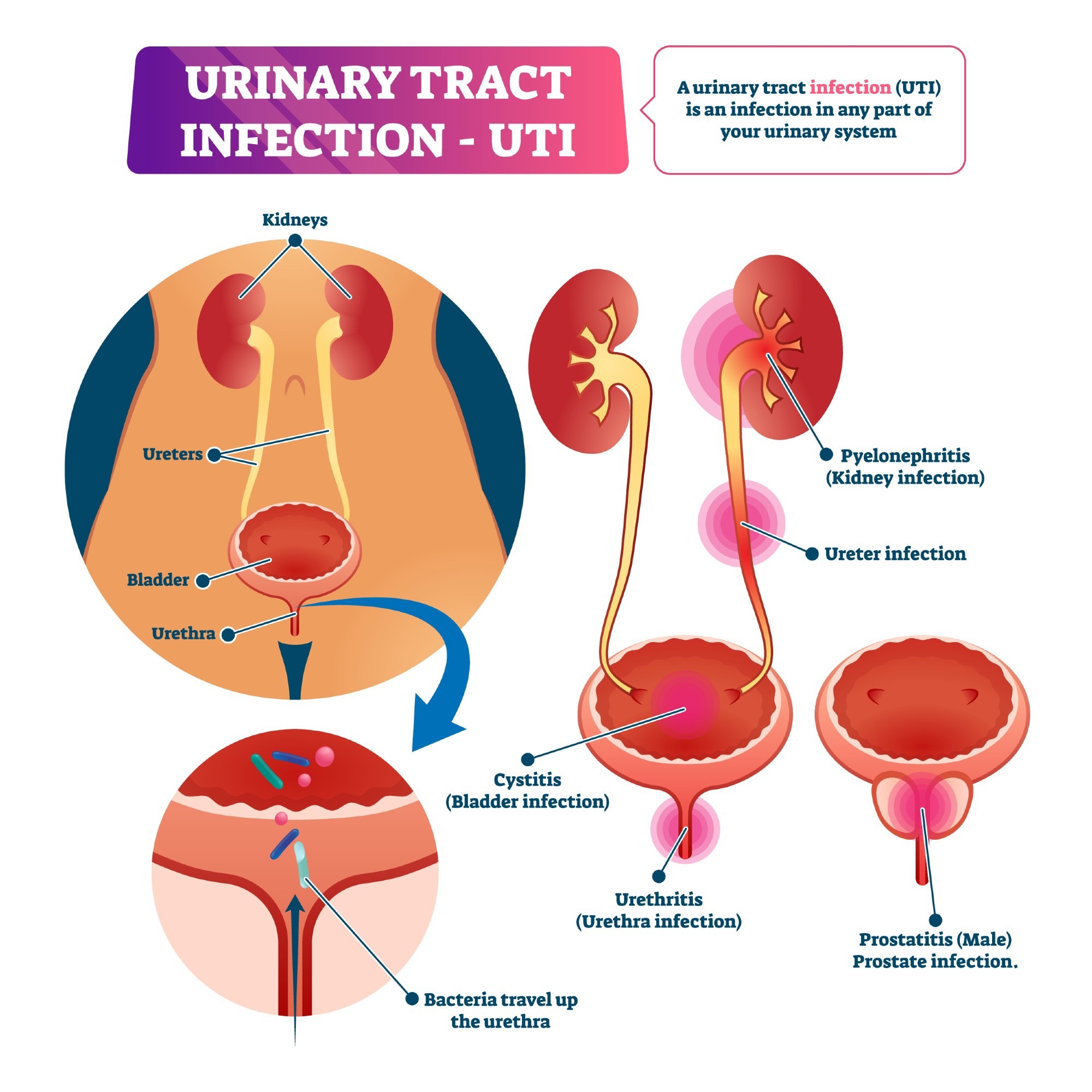 Urinary tract infection (UTI)