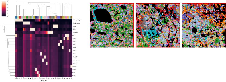 Unsupervised Analysis Shows Checkpoint Loss and T Cell Exclusion in mCRPC