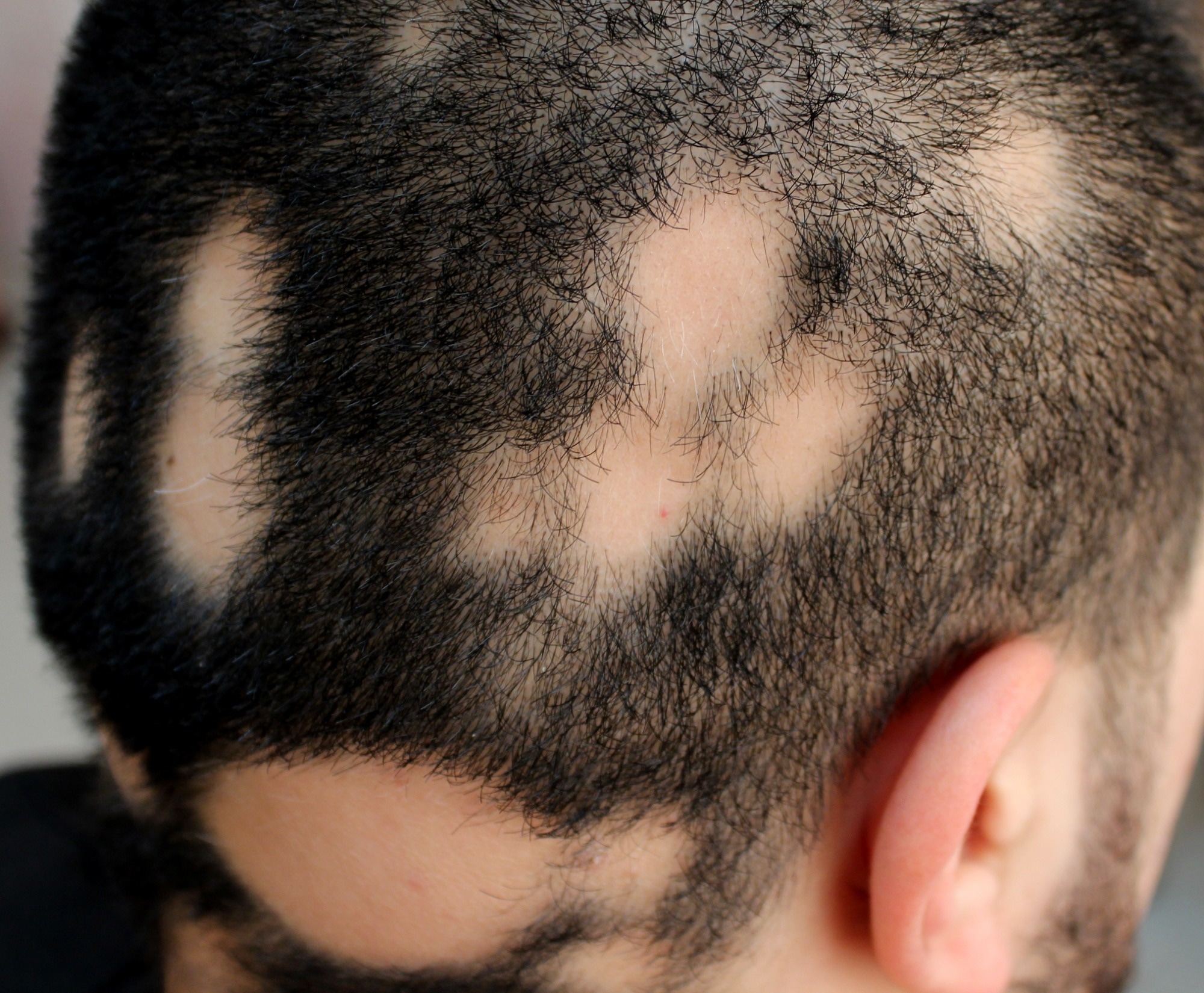 A case of alopecia areata in a male. Image Credit: Dermatology11 / Shutterstock
