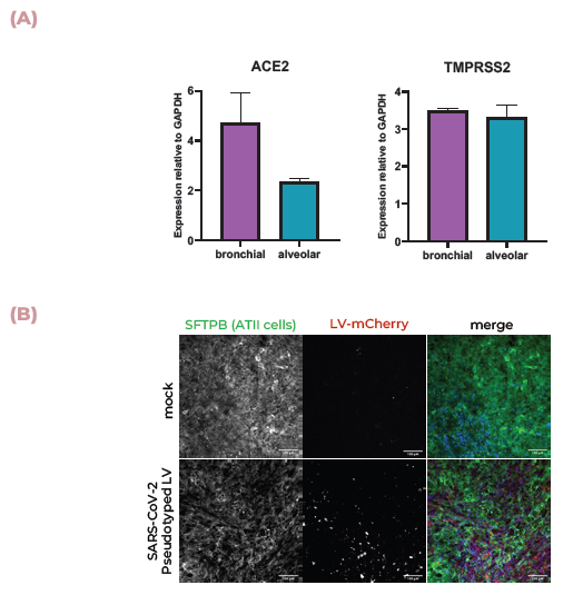 Lung MPS are infected by SARS-CoV-2 and produce an inflammatory response. (A) ACE2 and TMPRSS2 mRNA expression in alveolar and bronchial MPS cultures were measured using qPCR. (B) Pseudotyped lentivirus expressing the SARS-CoV-2 Spike (D614G) protein tagged with mCherry was used to infect alveolar cultures. Tissues were fixed and stained for SFTPB (green), DNA (blue) and mCherry (red). Scale bar, 100 μm. (C) Pseudotyped lentivirus expressing the SARS-CoV-2 Spike (D614G) protein tagged with mCherry was used to infect alveolar cultures with THP-1 monocytes (tagged with far-red Cell Tracker (orange)). Tissues were fixed and stained for mCherry (red), actin (green) and DNA (blue). Scale bar, 100 μm. (D) TNFα, IL-1β and IL-6 expression were measured using ELISA over 48 hrs during infection.