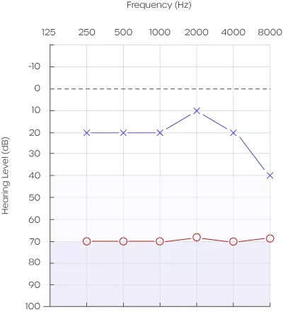 Example of Asymmetrical hearing loss in the right ear