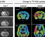 Atorvastatin-loaded PEGylated liposomes for ischemic stroke treatment