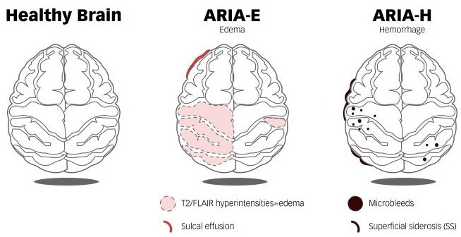 MRI Comparison Between a Healthy Brain and a Brain with ARIA-E and ARIA-H