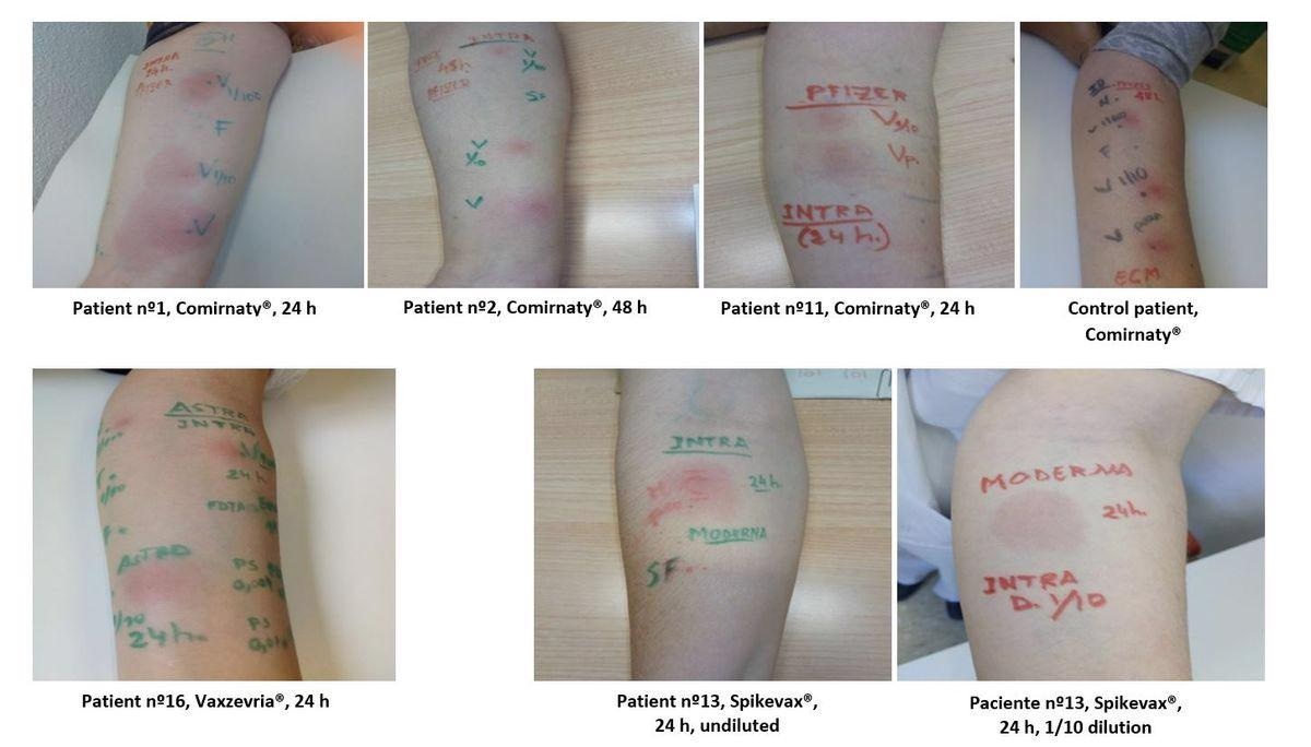 IDT with Comirnaty®, Vaxzevria® and Spikevax®   F or SF: control with saline solution; Vp: undiluted vaccine; V1/100: 1/100 diluted vaccine; V1/10: 1/10 diluted vaccine