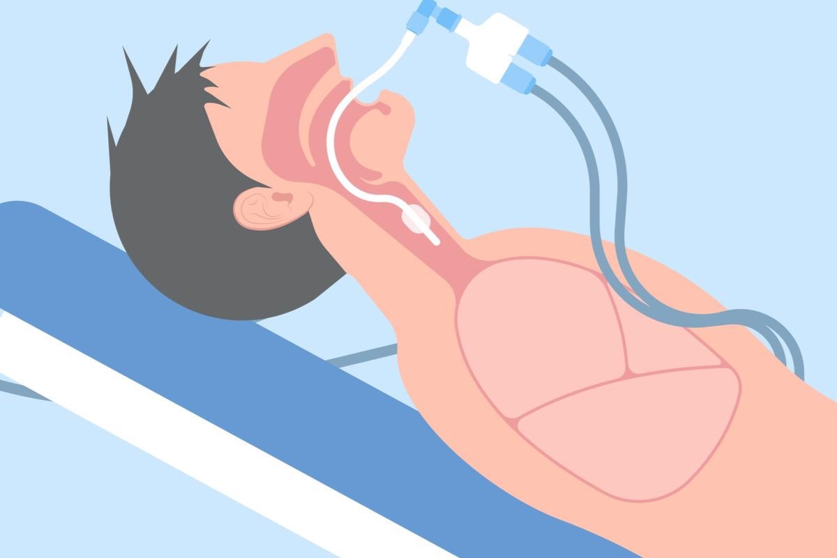 Study: Polymorphism in IFNAR contributes to glucocorticoid response and outcome in ARDS and COVID-19. Image Credit: rumruay/Shutterstock