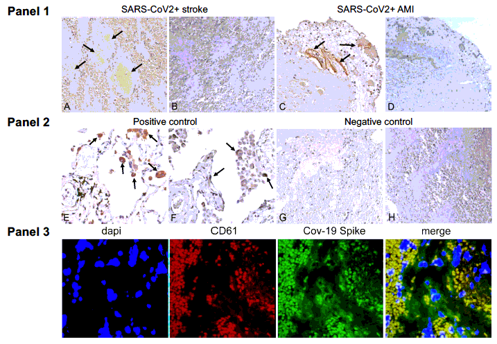 Arterial thrombi from Covid-19+ patients contain Sars-CoV-2 SP but not N protein Panel 1. Positive immunostaining for SARS-CoV-2 Spike protein (SP) (arrows) in representative thrombotic material from COVID19+ patients, retrieved from cerebral (A) and coronary (C) arteries. Immunohistochemistry for Nucleocapsid protein (NP) was negative in the same samples (B-D). Panel 2. Representative positive immunohistochemical staining for SP (E) and NP (F) (arrows) in the lung of a patient affected by COVID-19 (positive control). Representative negative immunostaining for SP (G) and NP (H) in a thrombus retrieved from the middle cerebral artery of a patient not affected by COVID-19 (negative control). Original magnification 20X. Panel 3. Double immunofluorescence of thrombotic material retrieved from COVID19+ patient cerebral artery. Platelets are stained with antibodies CD61 (red) and SARS-CoV-2 Spike Protein (SP) (green). Overlap of SARS-CoV-2 SP and platelets is shown in yellow (merge).