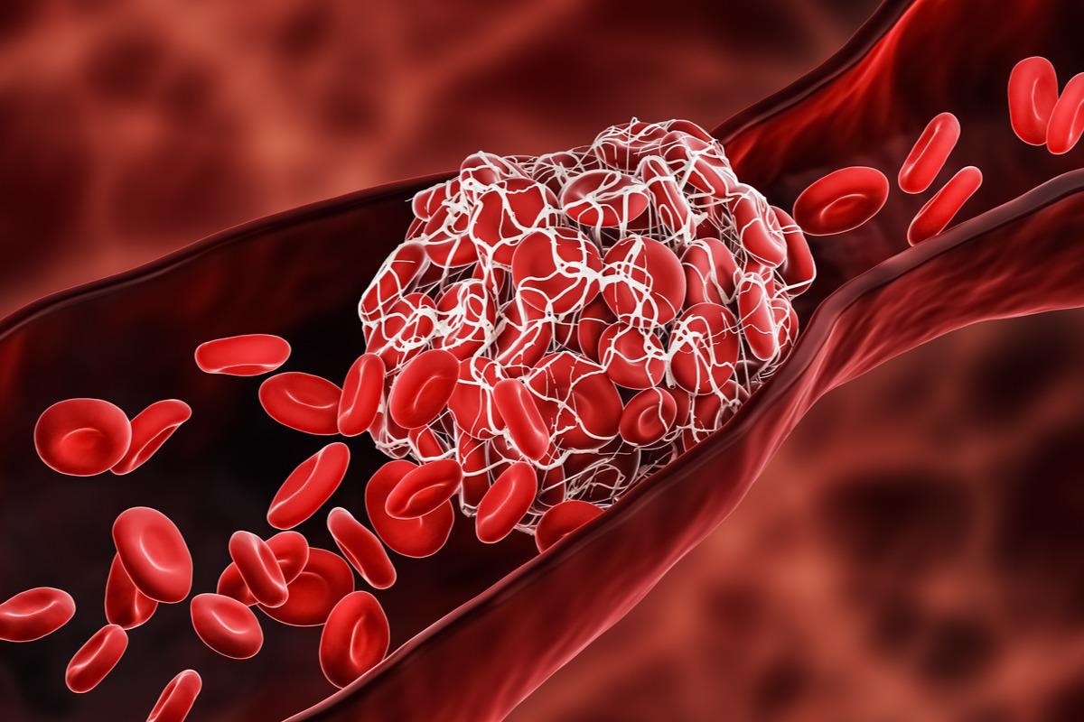 Study: Venous or arterial thrombosis and deaths among COVID-19 cases: a European network cohort study. Image Credit: MattLphotography/Shutterstock