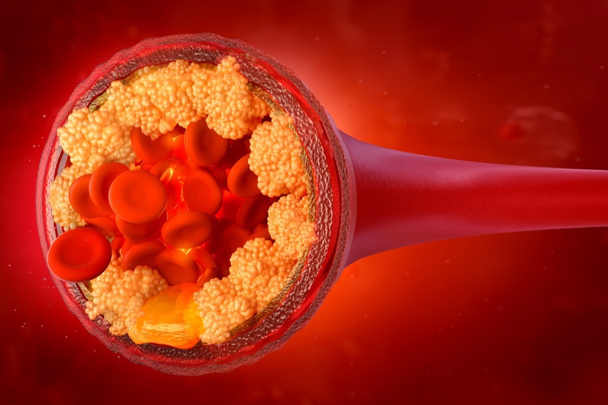 Study: LDL Cholesterol—How Low Can We Go? Image Credit: Corona Borealis Studio/Shutterstock