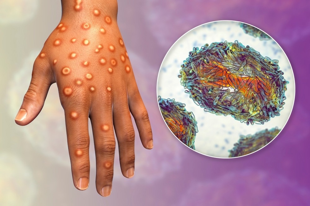 Study: It’s Here, Monkeypox: A Case Report. Image Credit: Kateryna Kon / Shutterstock.com