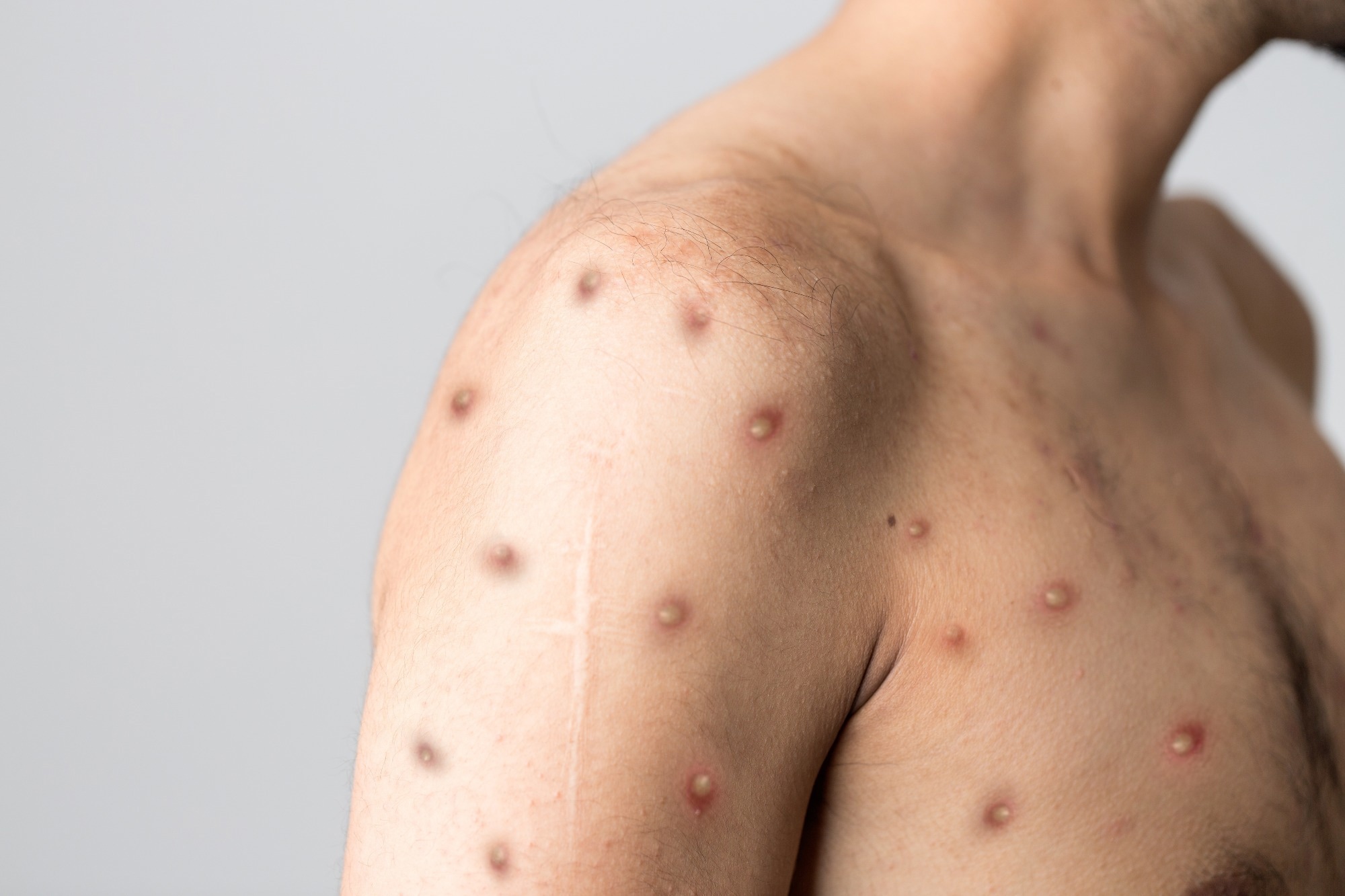 Study: High-Contact Object and Surface Contamination in a Household of Persons with Monkeypox Virus Infection — Utah, June 2022. Image Credit: Berkay Ataseven/Shutterstock