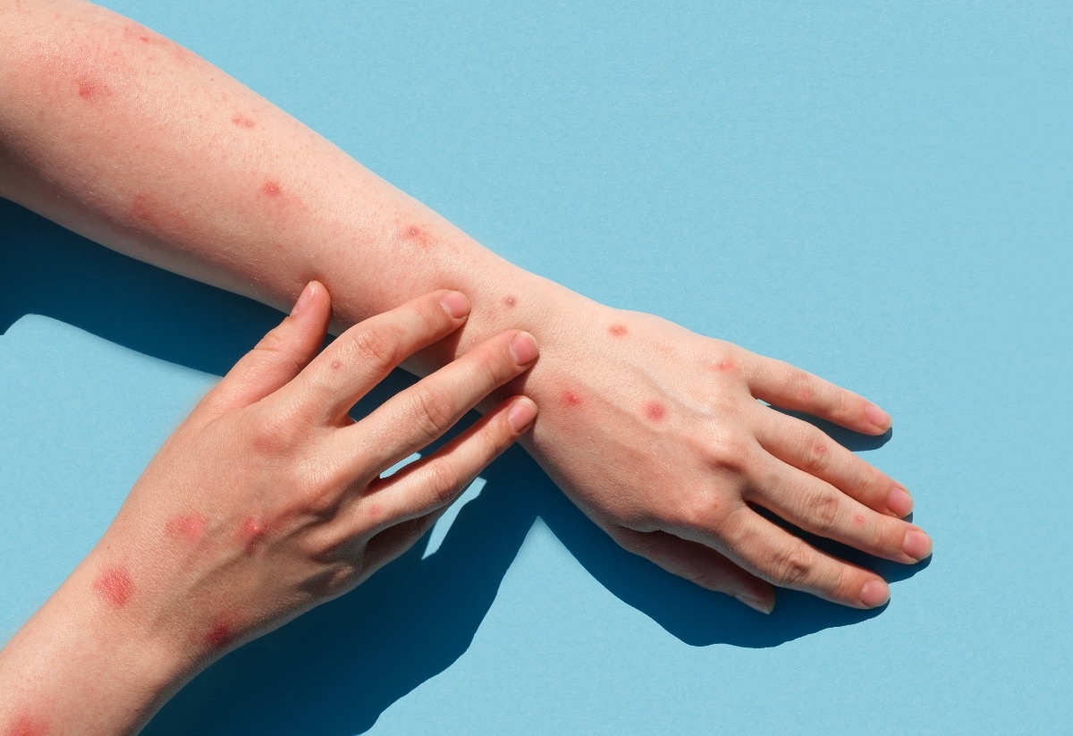 Study: Clinical Use of Tecovirimat (Tpoxx) for Treatment of Monkeypox Under an Investigational New Drug Protocol — United States, May–August 2022. Image Credit: Marina Demidiuk/Shutterstock