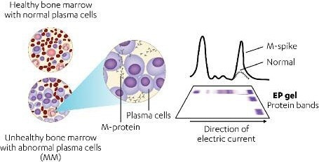 How to assess clinical response in multiple myeloma
