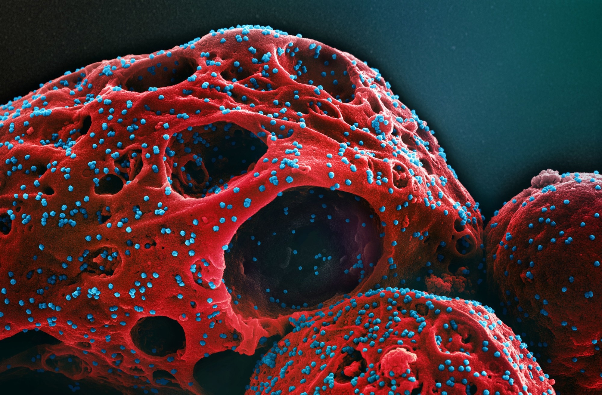 Study: In simple terms, MIS-C is the manifestation of a strong response of monocytes or other mononuclear phagocytes to SARS-CoV-2 dsRNA intermediates.. Image Credit: NIAID