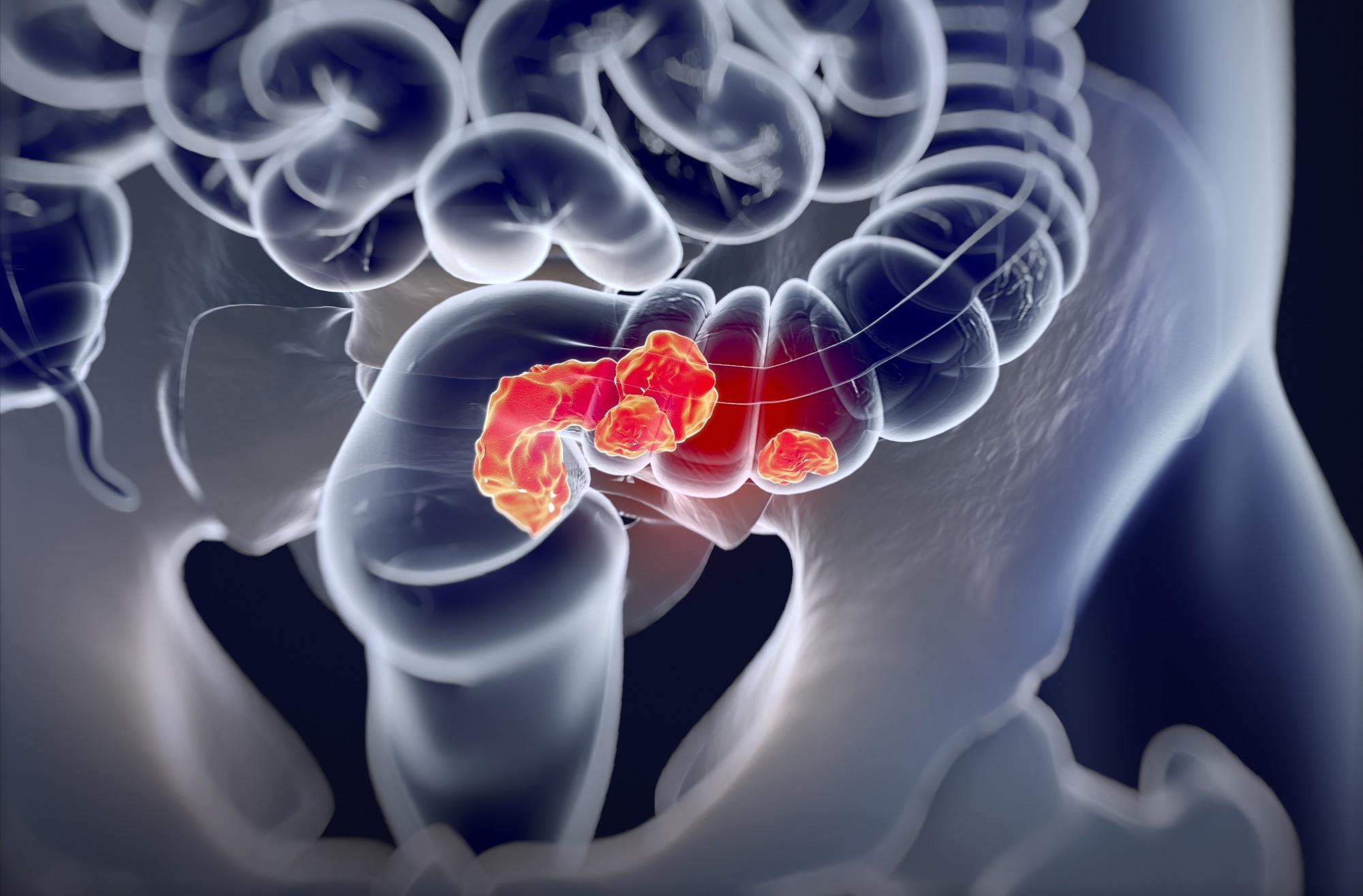 Perspective: A common cancer at an uncommon age. Image Credit: Anatomy Image / Shutterstock