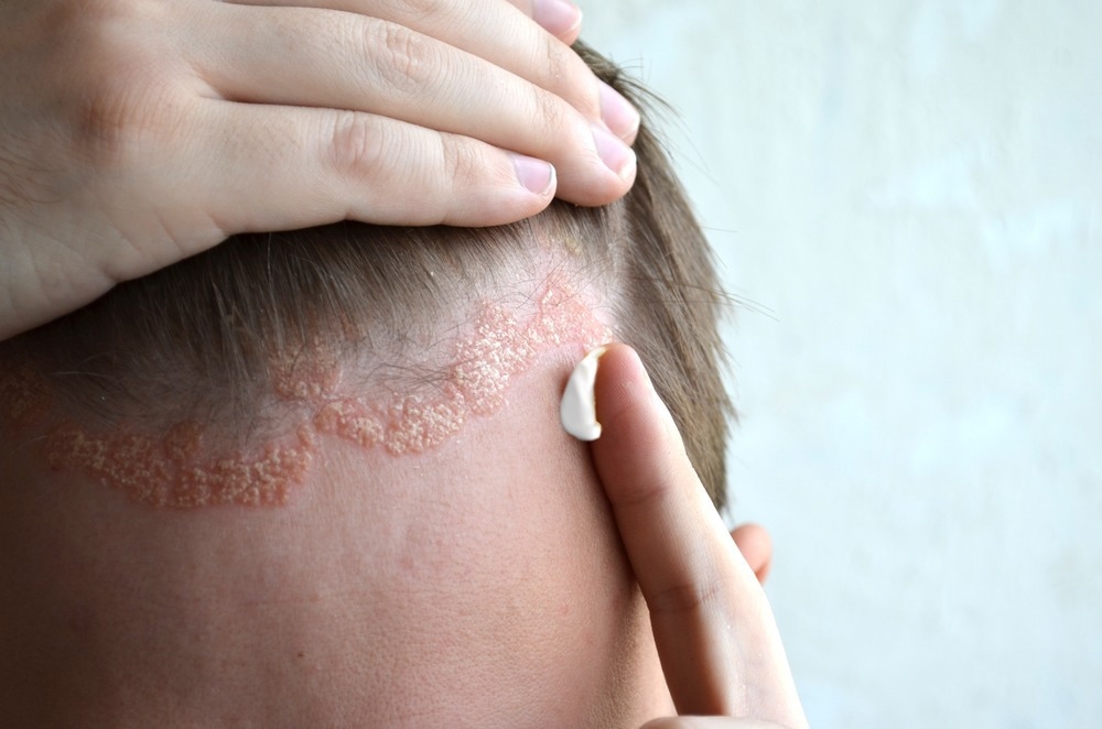 Study: Multi-omics segregate different transcriptomic impacts of anti-IL-17A blockade on type 17 T-cells and regulatory immune cells in psoriasis skin. Image Credit: Anatolev/Shutterstock.com