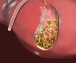 Genetic twist in gallstone disease may shield against heart attacks
