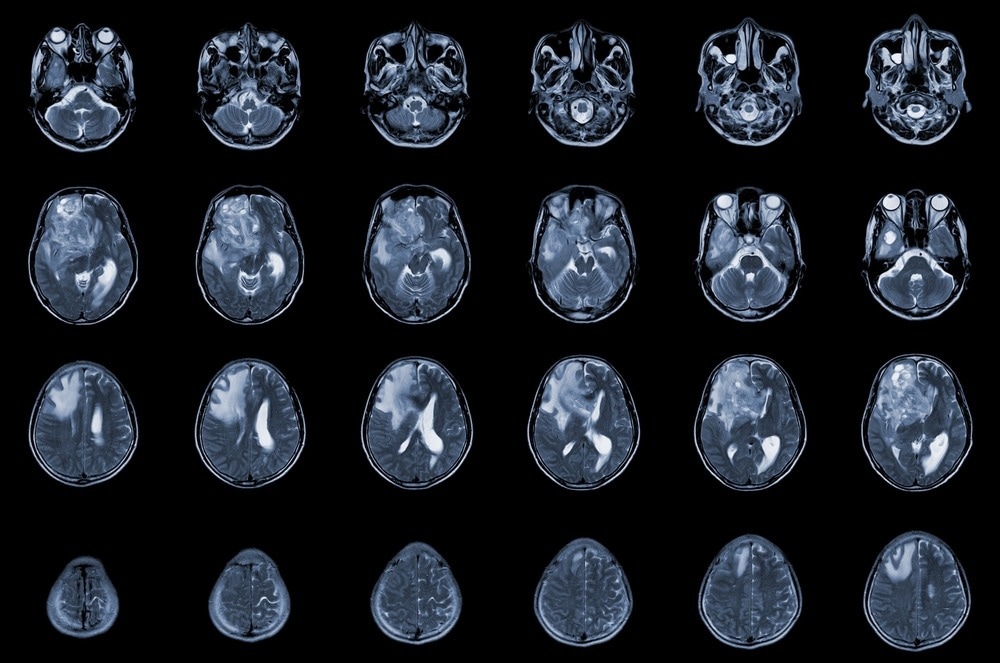 MRI brain axial view showing an isodense mass with ill-defined margins and surrounding edema in the right frontal lobe, consistent with glioblastoma and brain metastasis