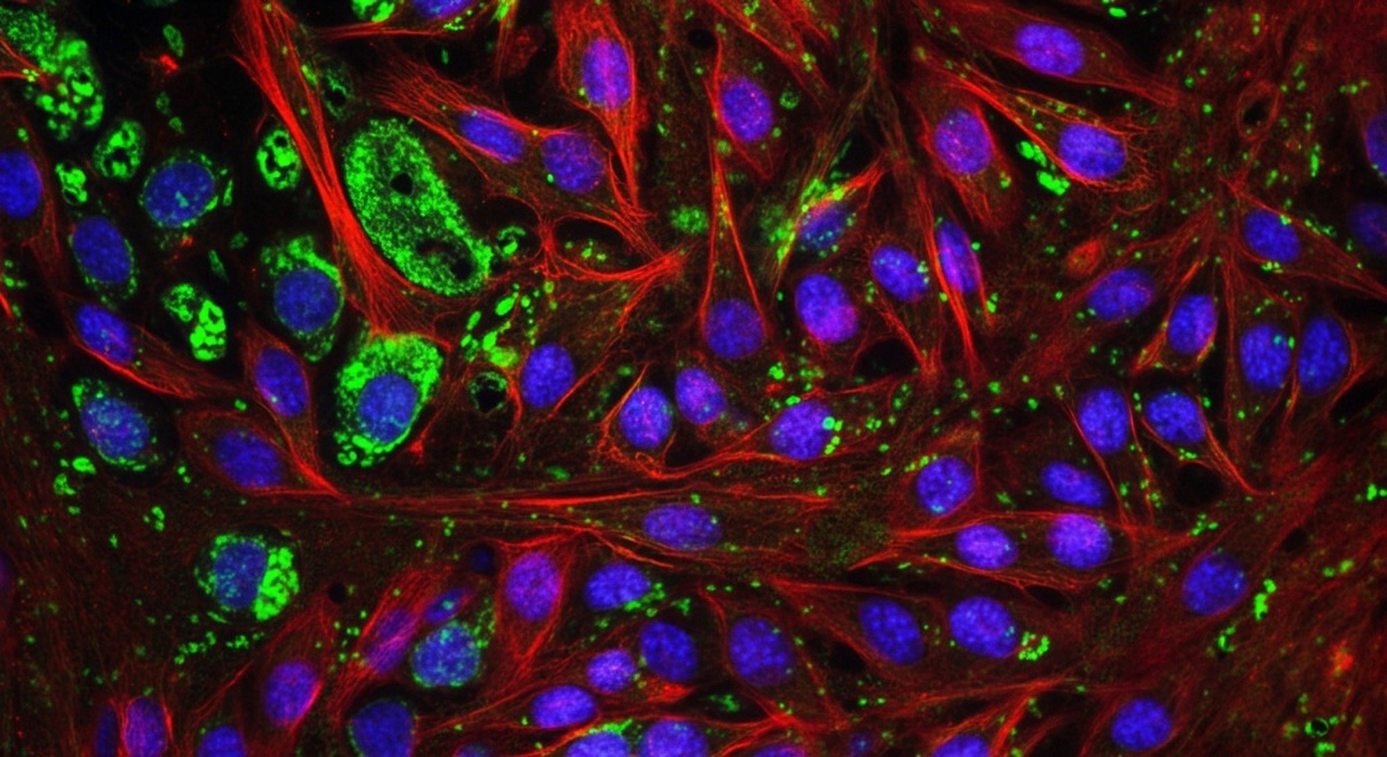 Study: Spatial transcriptomics reveals substantial heterogeneity in triple-negative breast cancer with potential clinical implications